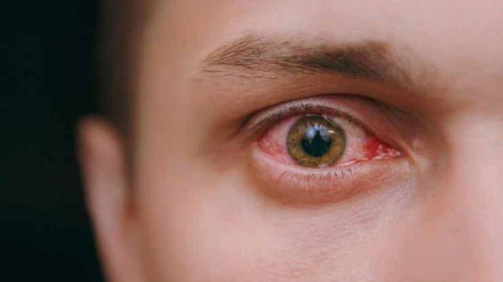 Aumentan casos de conjuntivitis en una semana en Tamaulipas