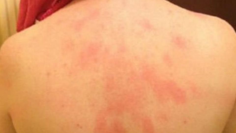 Los síntomas van desde urticaria en la piel, hasta fiebre y migraña.