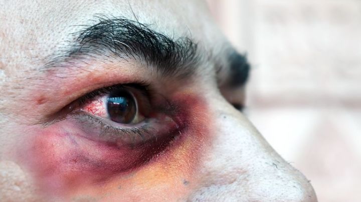 COVID EN EL MUNDO: El hongo negro puede estar en tu casa sin darte cuenta