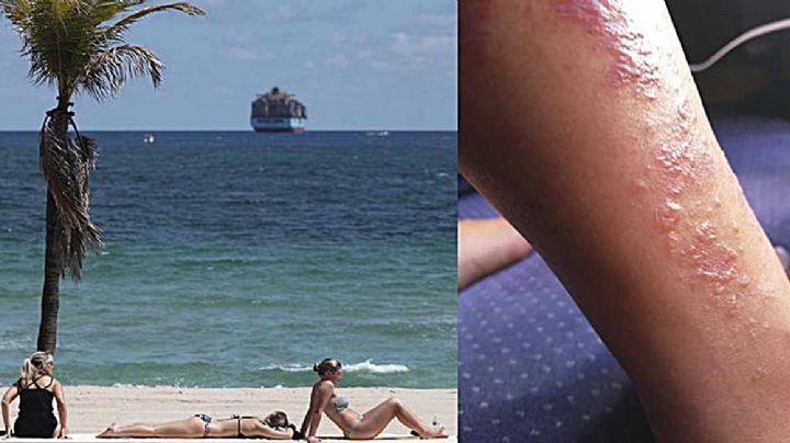 Mujer se infecta con la bacteria “come carne” en una playa de Florida
