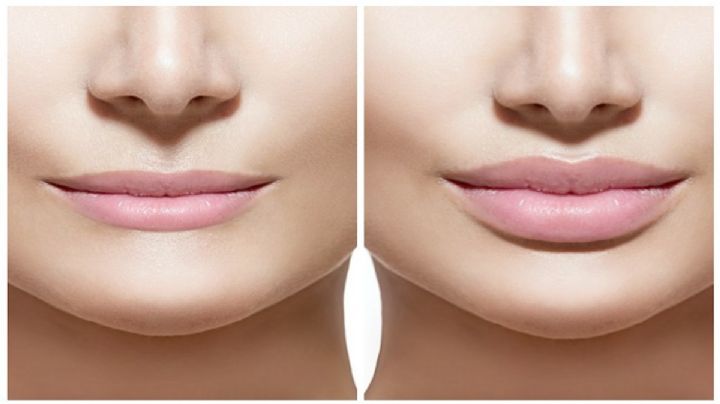 Aumento de labios: la cirugía plástica más popular en Texas ¿Cuánto cuesta?