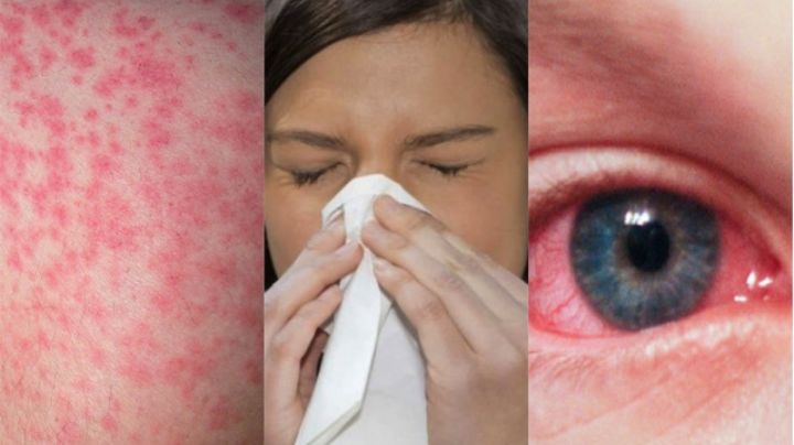Alergias y Coronavirus: las claves para diferenciar cada padecimiento