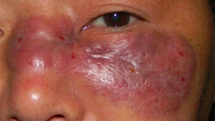 Mueren cinco de ocho casos de hongo negro en Sinaloa; ¿Cuáles son sus síntomas?