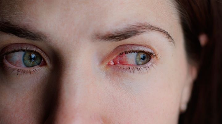 Conjuntivitis síntoma del Covid común en variante Ómicron