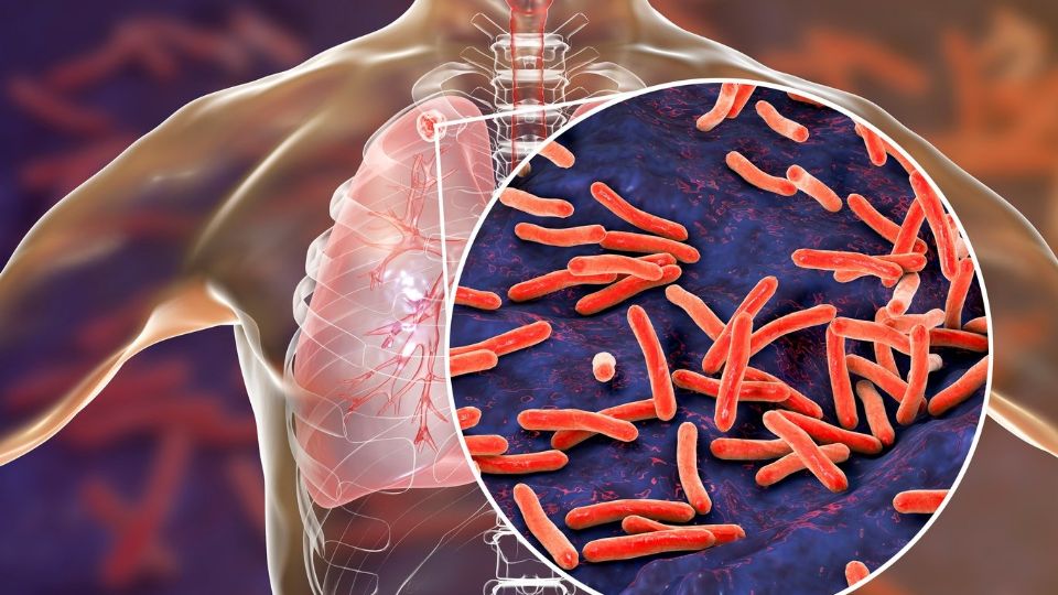 En la localidad se tienen 238 pacientes bajo tratamiento contra la tuberculosis