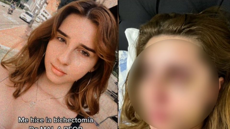 La joven mostró el resultado fatal de una cirugía estética