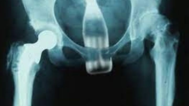 Abuelito acude a emergencias para que le retiren una botella atorada en el colon