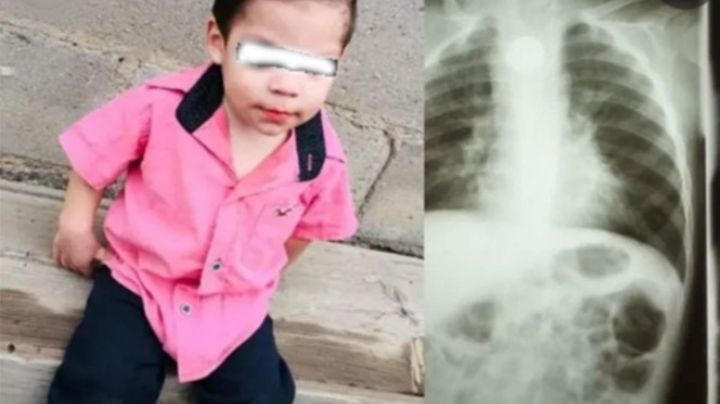 Bebé de dos años se come pila y sufre fuertes quemaduras; está en terapia intensiva