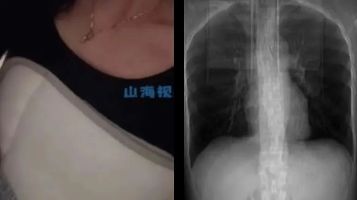 Mujer tose tan fuerte que se "rompe" por dentro | FOTOS