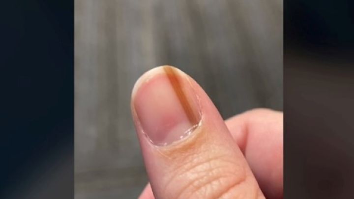 Por peculiar mancha en una uña, mujer fue operada 10 años después ¡tenía cáncer!