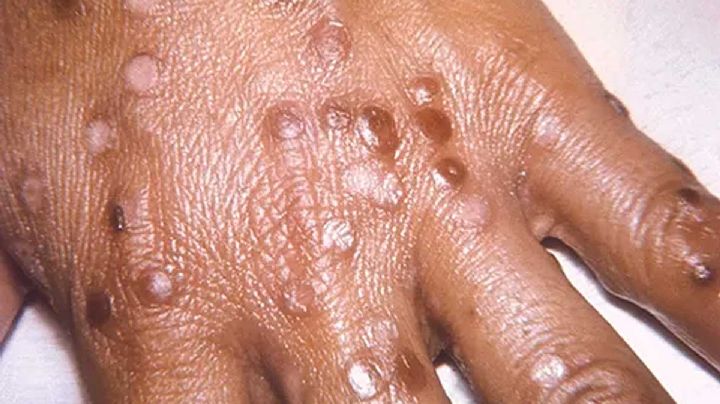 ÚLTIMA HORA: Se presenta primer caso de viruela del mono en EU