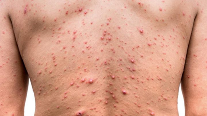 Argentina confirma primer caso de Viruela del Mono en su territorio