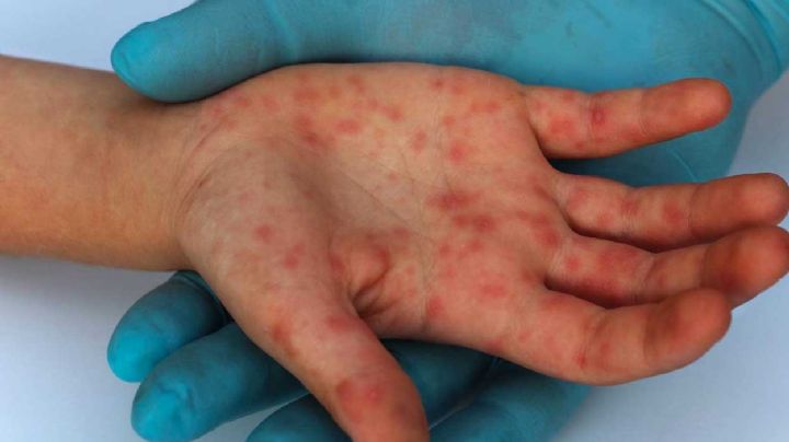 Detectan en Nuevo León dos casos más de viruela símica