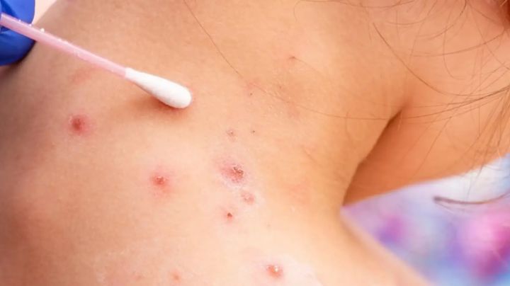 OMS preocupada por expansión de viruela del mono a grupos vulnerables