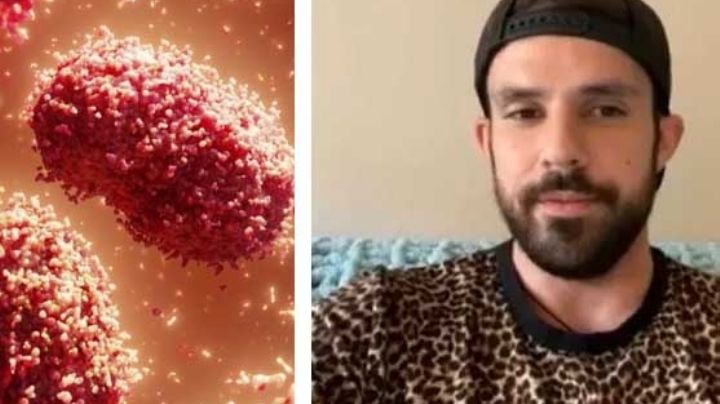 Texano dice que viruela del mono es 100 veces peor que el covid; padeció las dos infecciones