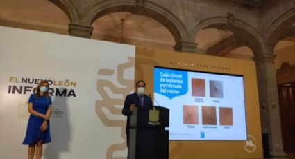 Detectan primer caso de viruela símica en Nuevo León