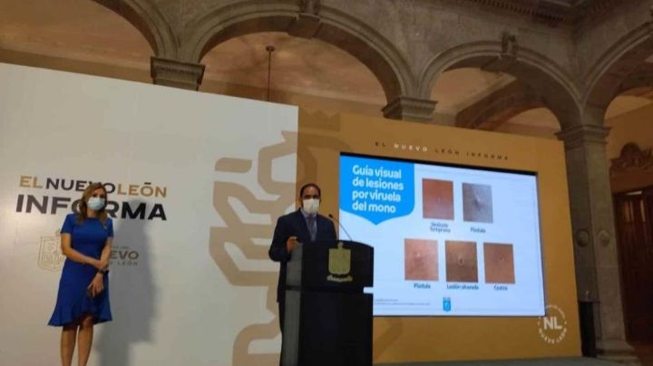 Detectan primer caso de viruela símica en Nuevo León