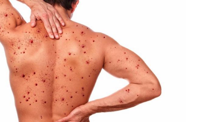 Confirman primer caso de Viruela del Mono en Colima