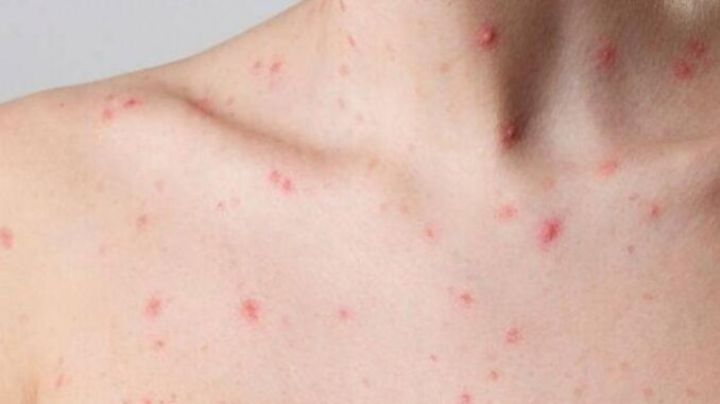 Nueva York reporta el primer caso de viruela del mono en un niño