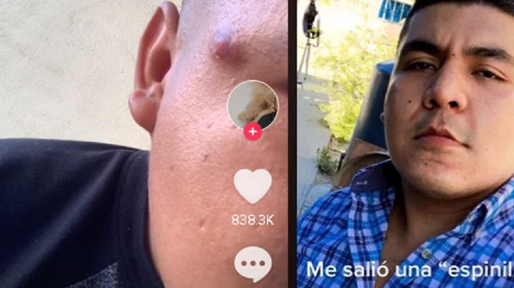 Joven pensó que tenía un barro en la cara, pero resultó ser un tumor I VIDEO