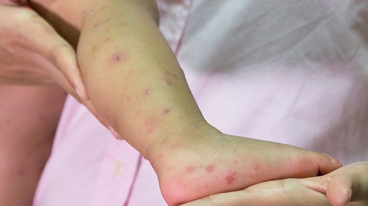 Registran brote de Coxsackie en DIF de Nuevo León; ¿qué es?