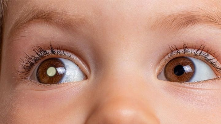 ¿Le brilla un ojo a tu niño en las fotos?: cuidado, podría tener una enfermedad mortal