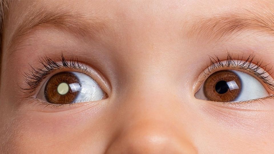 Retinoblastoma, una enfermedad mortal