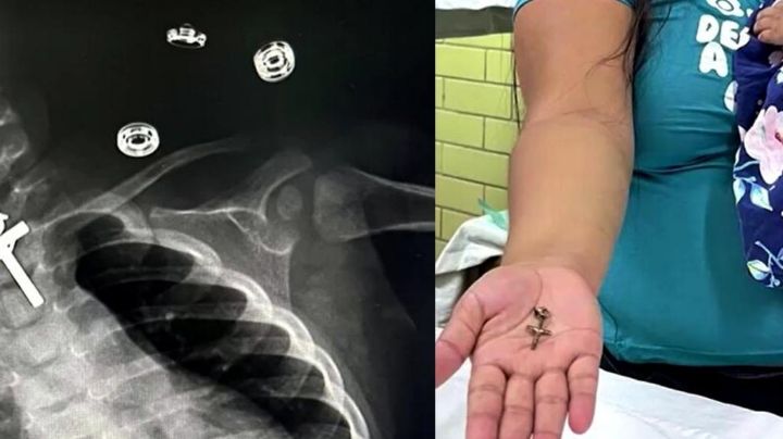 Llevan de urgencia a hospital a bebé por asfixia; las radiografías mostraron su 'travesura'