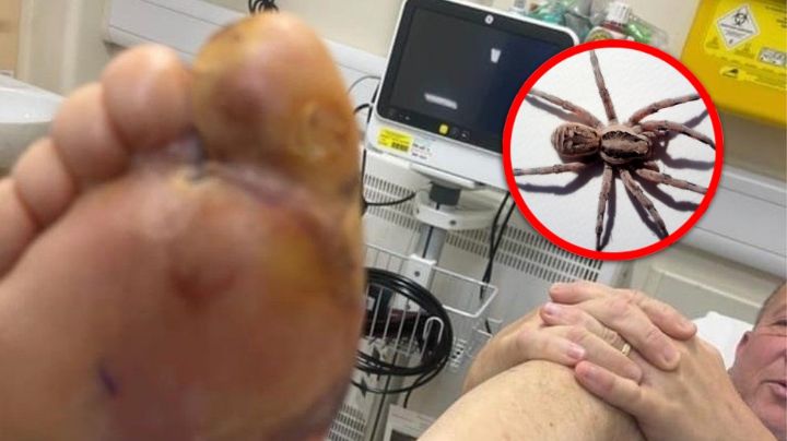 Araña lobo muerde el dedo de un hombre y le inyecta huevecillos | FOTO