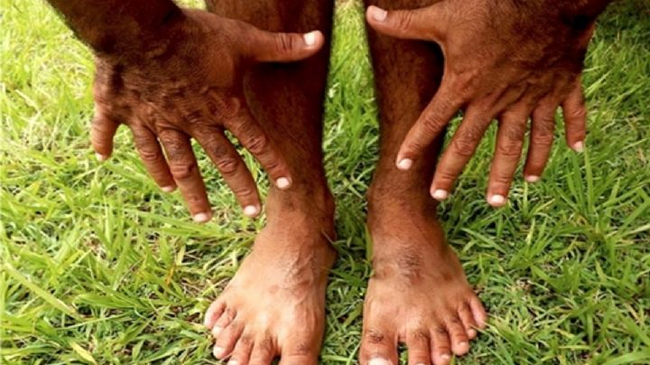 ¿Contaste bien? Entérate cómo vive este hombre con 24 dedos