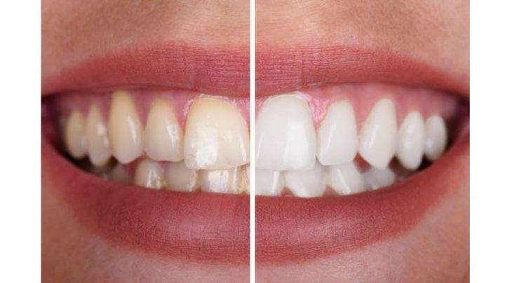 Higiene bucal: Cómo mantener los dientes blancos