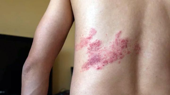 Culebrilla, las dolorosas ronchas que aparecen en el cuerpo; ¿el covid disparó los casos?