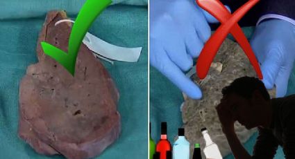 La cirrosis podría matarte; tal vez ya está en tu cuerpo
