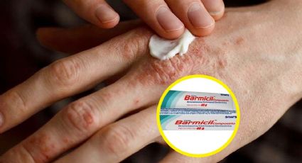 ¡Cuidado! Alertan por crema Barmicil; podría causar este síndrome