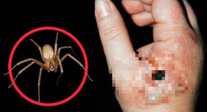 Así luce una picadura de araña violinista; atiéndete a tiempo