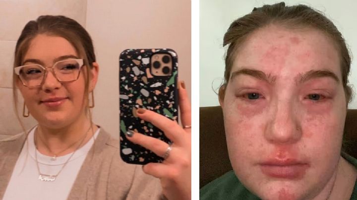 Mujer es alérgica a su novio; cada vez que está con él le sale "roña"