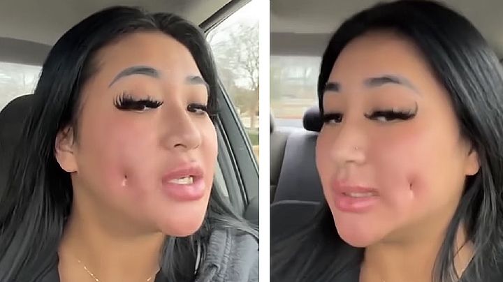 Gasta mil 500 dólares para tener hoyuelos en las mejillas y cirujano plástico la desgracia