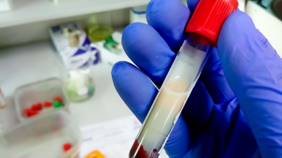 Con una prueba de sangre puedes conocer tu nivel de triglicéridos.