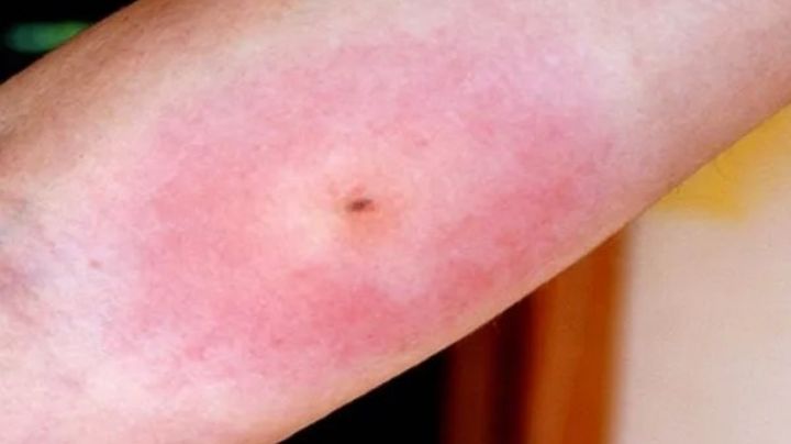 Así luce la picadura de una araña violinista | FOTO