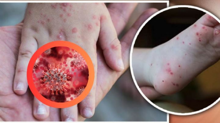 Brote de 'virus coxsackie' obliga al cierre temporal de escuelas; más de 30 niños afectados