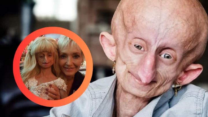 Muere a los 19 años Beandri Booysen, influencer que luchó contra la Progeria