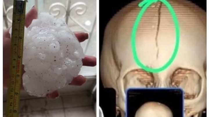 Granizo fractura cabeza a niña en Coahuila; está muy grave