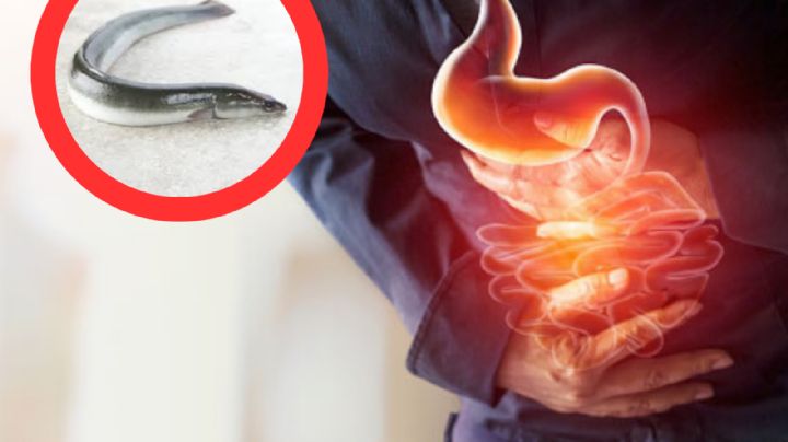 Acude al médico por un dolor y encuentran una anguila en el estómago