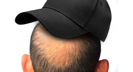 ¿Usar gorra te causa calvicie? La respuesta te sorprenderá