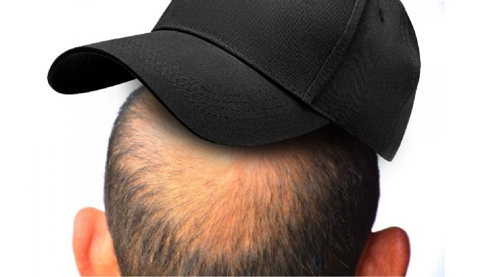 ¿Usar gorra te causa calvicie? La respuesta te sorprenderá