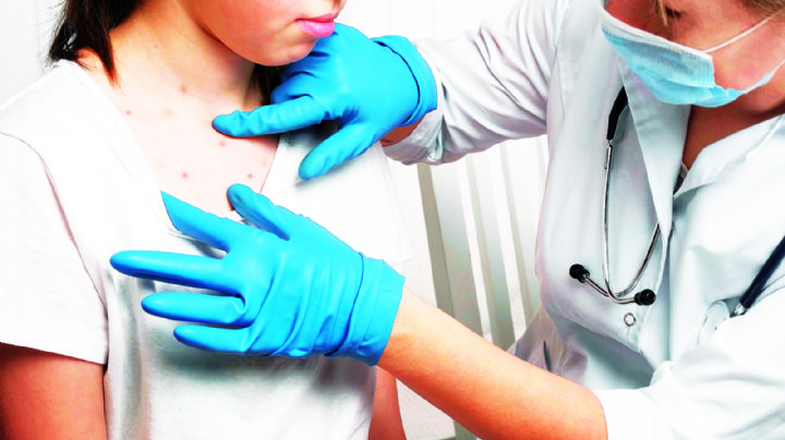 Repunta la varicela en Nuevo Laredo; reportan 205 casos