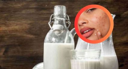 ¡No la consumas más!, esta es la leche que podría estar causando acné en tu piel, según la AAD