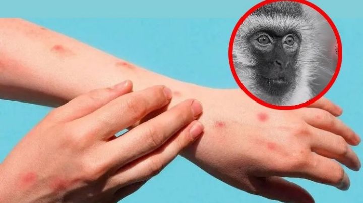 Brote de mpox: ¡Alerta en México!; confirman primeros casos del virus