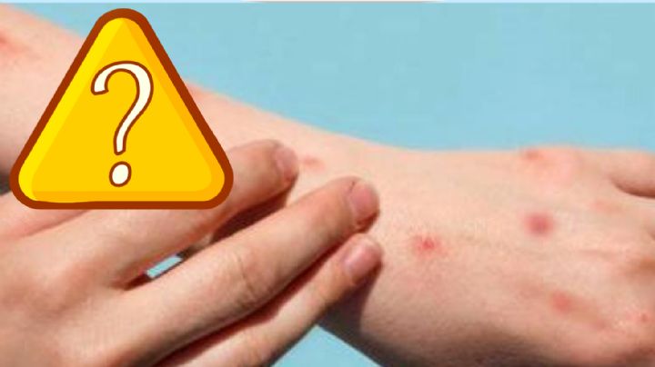 Mpox : estos son los estados de México con mayor número de casos; ¿cómo prevenirlos?