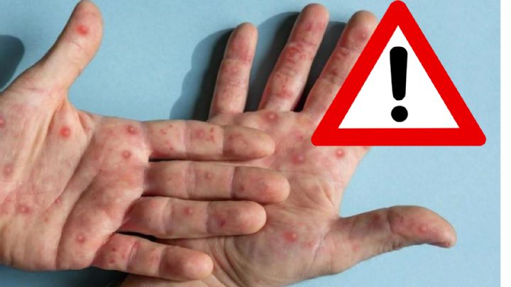 Mpox en México:¿qué dicen los expertos sobre esta enfermedad?